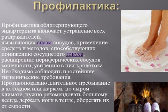 Профилактика облитерирующего эндартериита