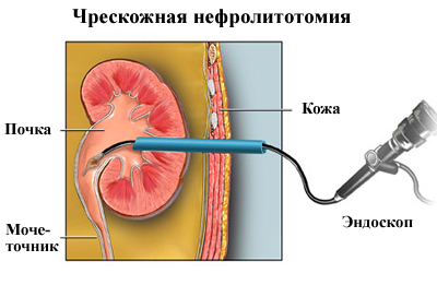 Лечение камней в почках народными средствами