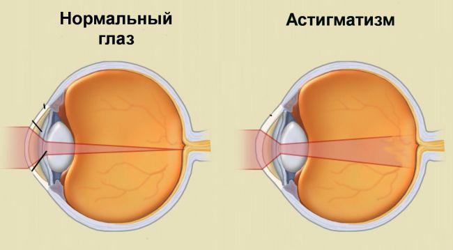 Современные методы лечения дальнозоркого астигматизма
