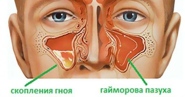 Как снять сильную головную боль при гайморите