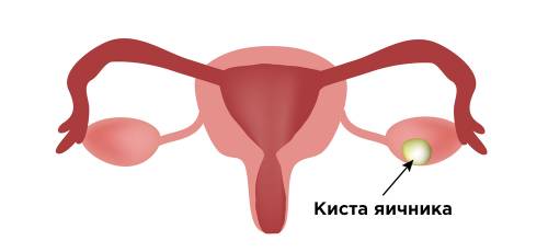 Виды кист яичников: классификация, фото