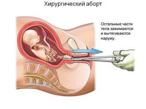 Искусственный аборт и его последствия