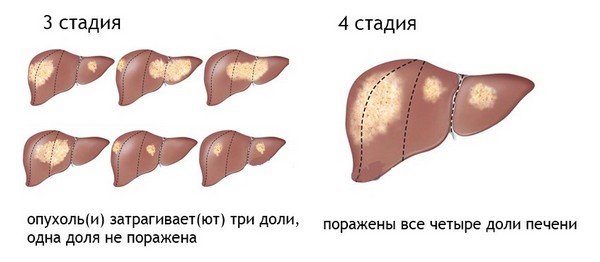 Что такое гемангиома сосудов печени?