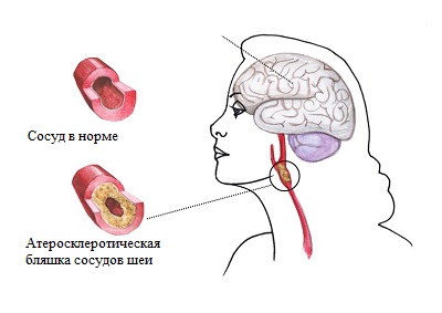 Энцефалопатия