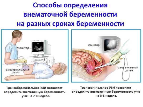 Внематочная беременность - все, что вы не знали о ней