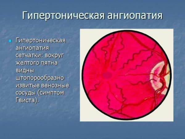 Ангиопатия сетчатки обоих глаз: что это такое, симптомы, лечение