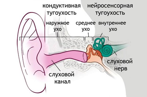 Тугоухость 2 степени – лечение у взрослых: восстановится ли слух