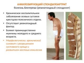 6 болезней, которые могут имитировать анкилозирующий спондилит (болезнь бехтерева)