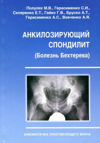Анкилозирующий спондилит что это такое