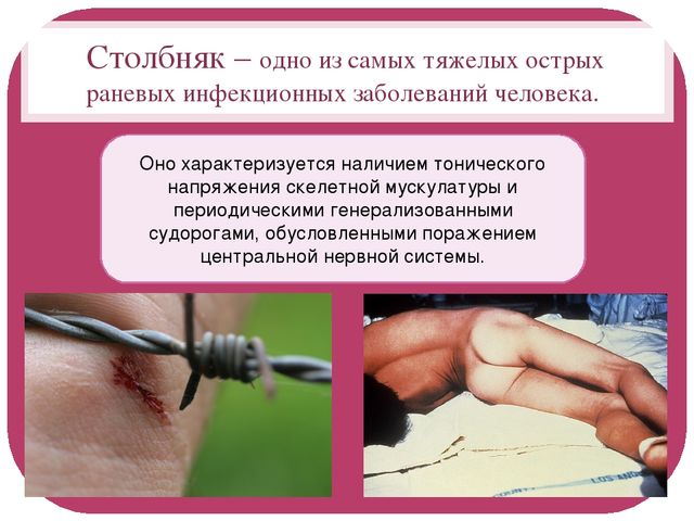 Столбняк: симптомы у человека и его лечение