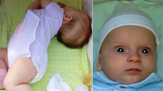 Внутричерепное давление у детей до года: как определить и как лечить