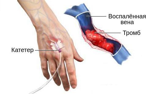 Флебит
