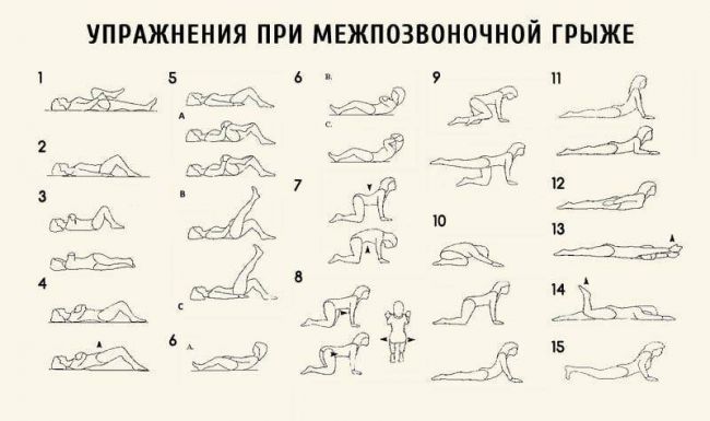 Реабилитация после удаления грыжи поясничного отдела позвоночника