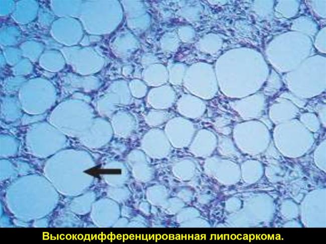 Липосаркома забрюшинного пространства: чем опасно новообразование