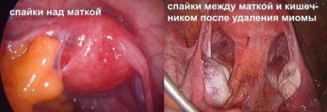 Почему образовываются спайки в кишечнике