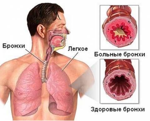 Бронхообструктивный синдром (бронхообструкция): причины, диагностика, лечение