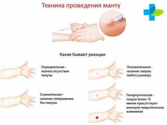Большая манту в 6 лет: опасность или же норма?