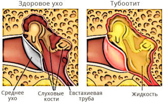 Лечение нейросенсорной тугоухости в домашних условиях
