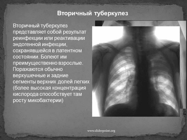 Туберкулезная палочка у детей