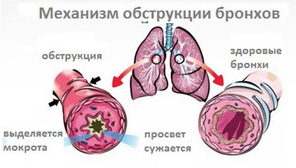 Можно ли гулять при бронхите зимой ребенку комаровский