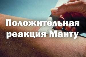 Медотвод от манту