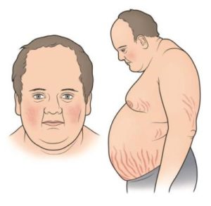 Болезнь иценко-кушинга