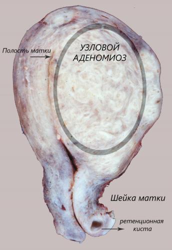 Аденомиоз матки