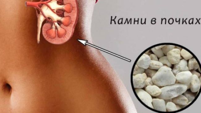 Травы для почек: лечение почек народными средствами