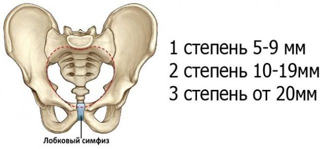 Симфизит при беременности