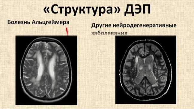 Энцефалопатия: формы, симптомы, лечение, диагностика