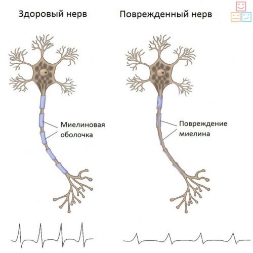 Диабетическая полинейропатия нижних конечностей: как распознать и вылечить?