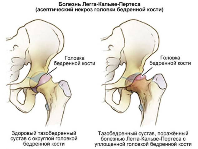 Болезнь легга-кальве-пертеса