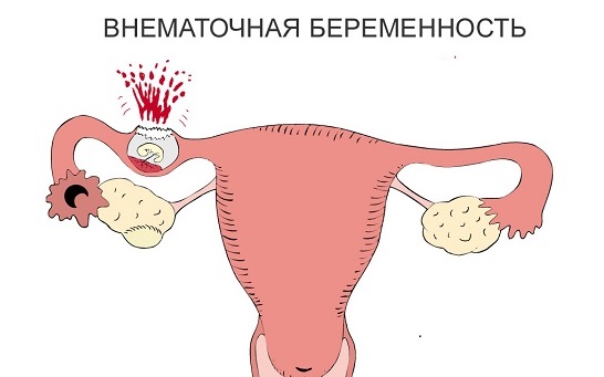 Внематочная беременность: признаки и симптомы на ранних сроках