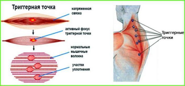 4 волшебные точки для снятия боли в спине