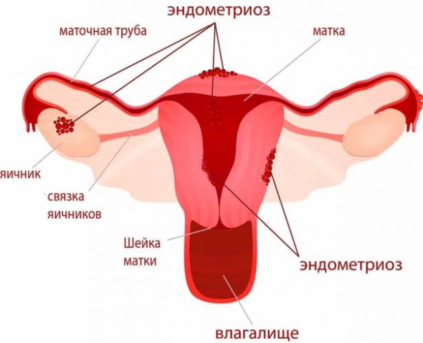 Причины кровянистых выделений между менструациями