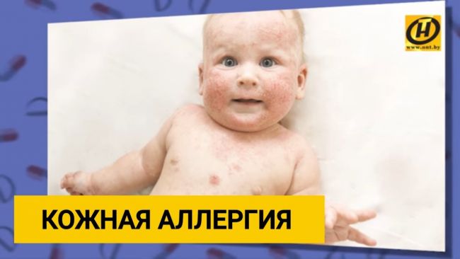 Аллергический дерматит у детей – что делать для лечения и профилактики?