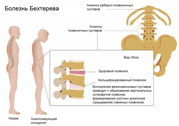 Анкилозирующий спондилит (болезнь бехтерева) - причины, патогенез, симптомы, диагностика, лечение, прогноз