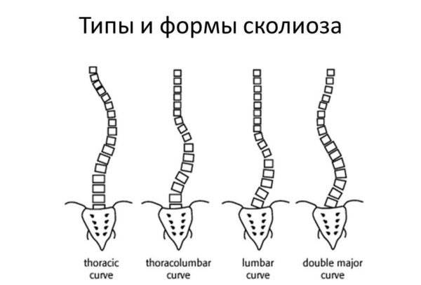 Как определить сколиоз на ранней стадии