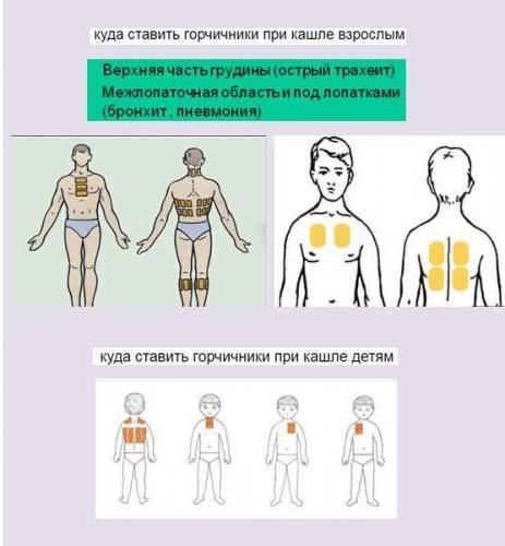 Горчичники при кашле детям и взрослым