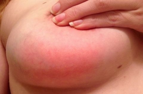 Нелактационный мастит у женщин: симптомы и лечение, народные средства
