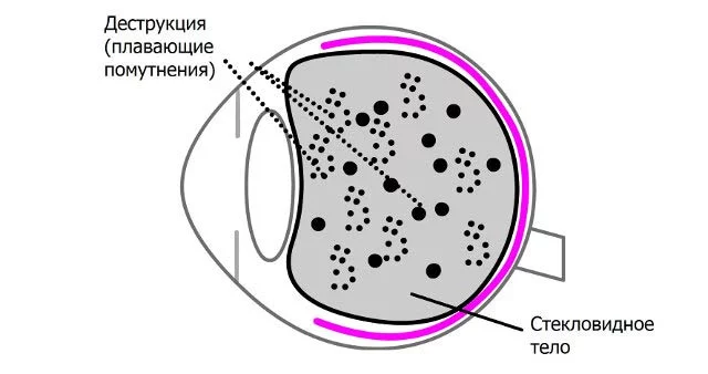 Деструкция стекловидного тела