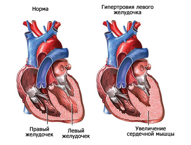 Гипертрофия левого желудочка сердца — что это такое? экг, признаки и лечение