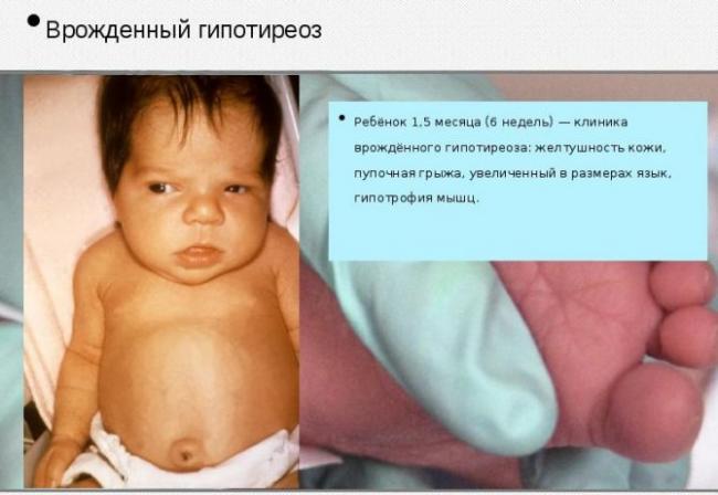 Субклинический гипотиреоз. что это такое, симптомы, лечение у женщин, детей, мужчин