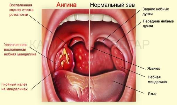 Чем полоскать горло при тонзиллите или обзор самых эффективных средств