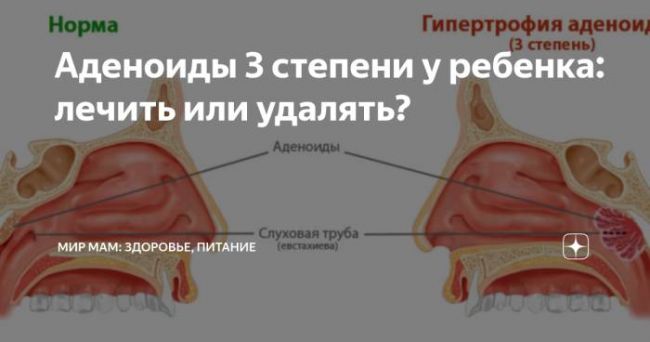 Схема лечения аденоидов