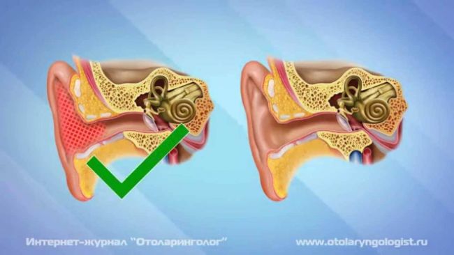 Серная пробка – что это такое и как убрать?