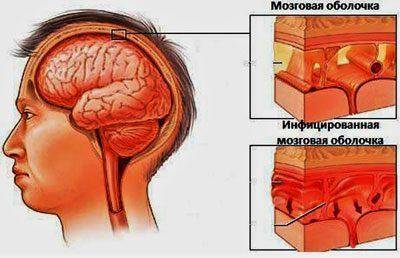 Недолеченная пневмония последствия у взрослых