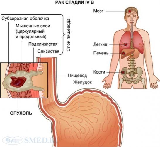 Питание после операции рака пищевода и желудка