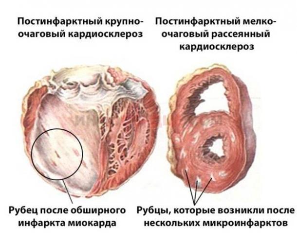 Постинфарктный кардиосклероз: что это, развитие, лечение, прогноз