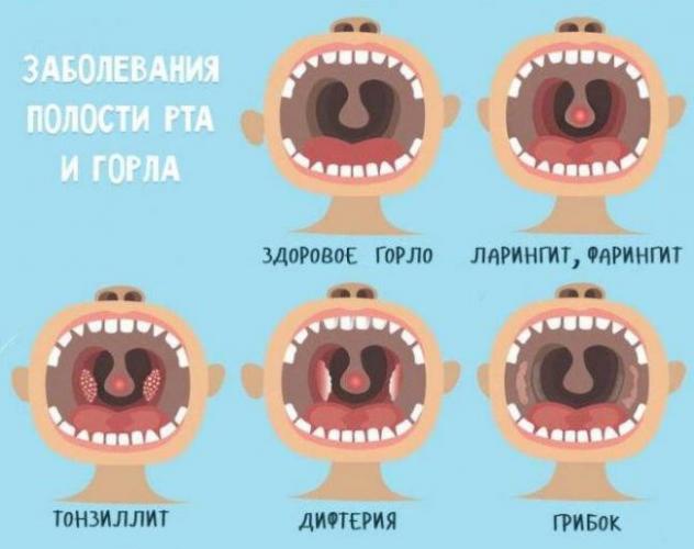 Лечение ларингита у взрослых препаратами, таблетками и антибиотиками